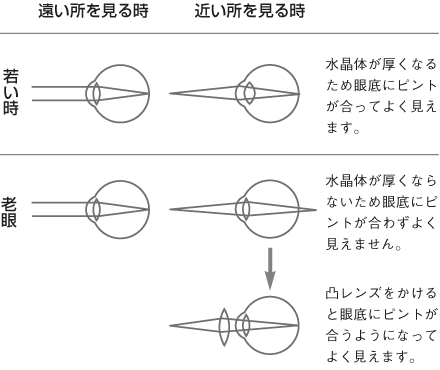 近いところを見るときに、水晶体が厚くならないため眼底にピントが合わずよく見えません。