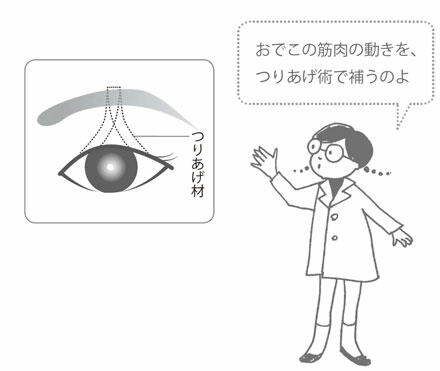 つりあげ術をする場合。・まぶたを上げる筋肉の動きが悪い場合・まぶたを上げる筋肉を支配する神経に麻痺がある場合