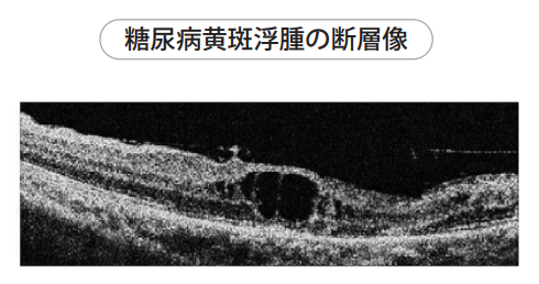 糖尿病黄斑浮腫の断層像